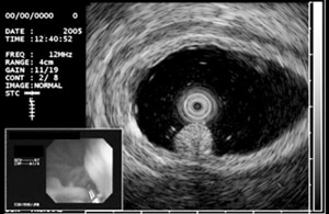 EUS antral adenoma EUS