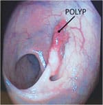 Polyp photo