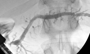 chronic pancreatitis diagnosis