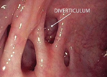 diverticulosis