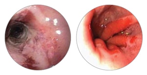 esophageal