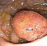 rectal polyp